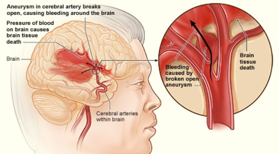  Stroke: not just an adult's condition
