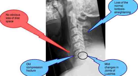 Disc symptoms slip Herniated Disc